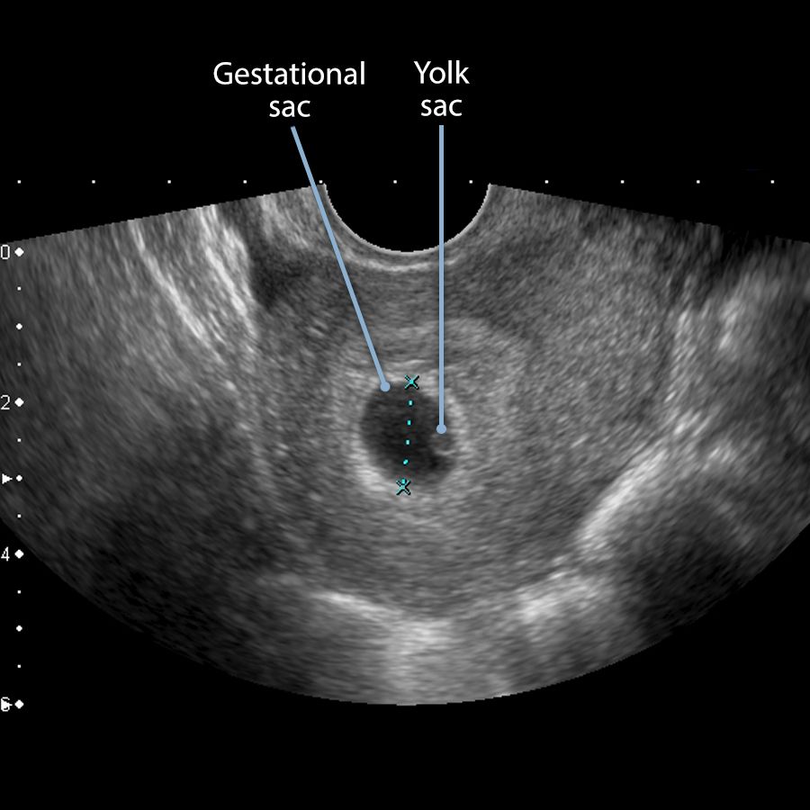 GS (Gestational Sac) – Đường kính túi thai